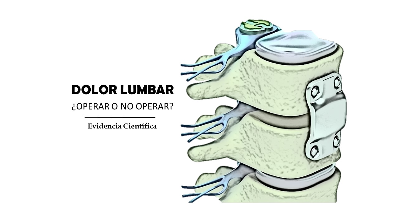 DOLOR LUMBAR ¿OPERAR O NO OPERAR?