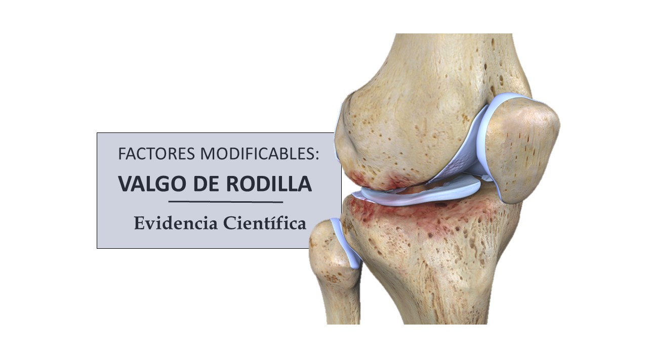 La Lesión del Ligamento Cruzado Anterior: prevención
