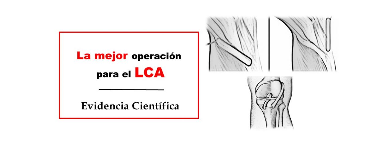 La mejor operación para el ligamento cruzado anterior LCA